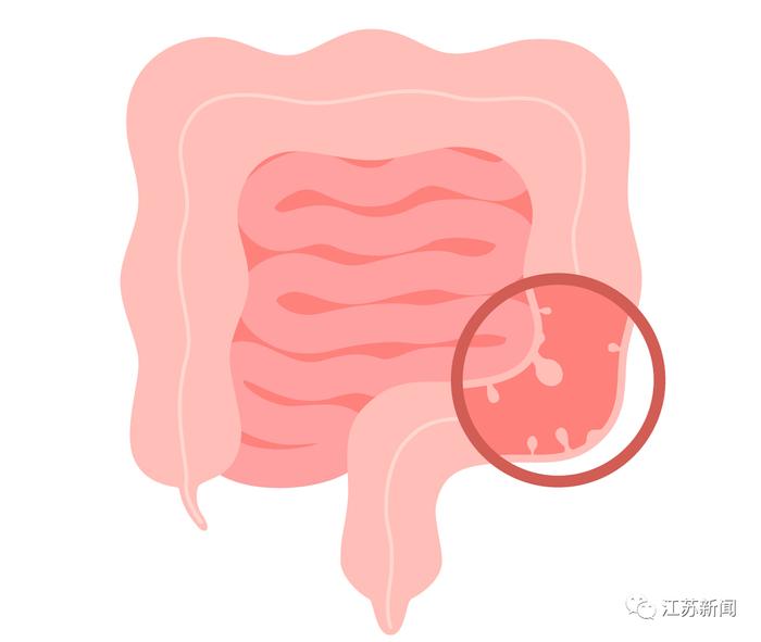 30岁小伙不幸患上肠癌，这种东西千万别多吃！