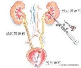 院庆50周年系列科普｜得了肾结石别紧张！泌尿外科教您如何护理？