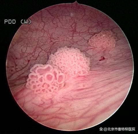 泌尿外科小科普：膀胱癌如何护理？