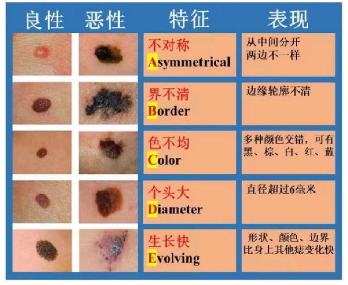 年轻歌手因黑色素瘤去世，如何预防“黑痣”恶变为“瘤”？