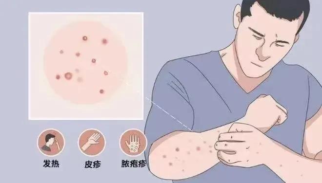 国内多地发现猴痘病例，如何保护自己？北京疾控最新提醒！