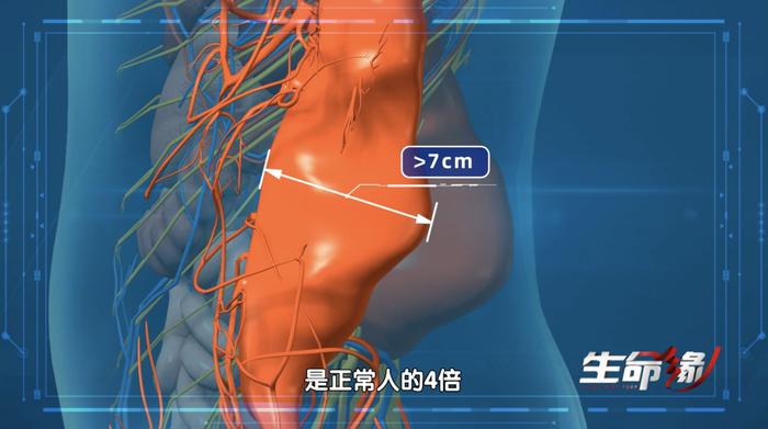 《生命缘》 | 主动脉夹层的高危因素是这种常见病