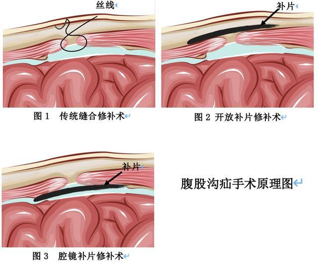 大腿根部出现肿块后又消失了？腹股沟疝究竟是什么？