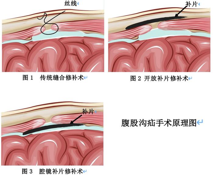 科普|大腿根部出现肿块后又消失了？腹股沟疝究竟是什么？