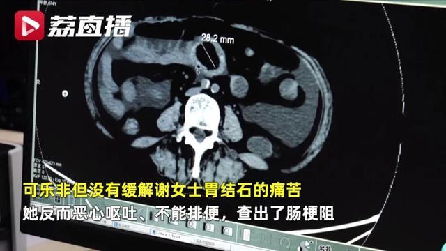 爱吃柿子患上胃结石，老人喝可乐来治，结果悲剧了……