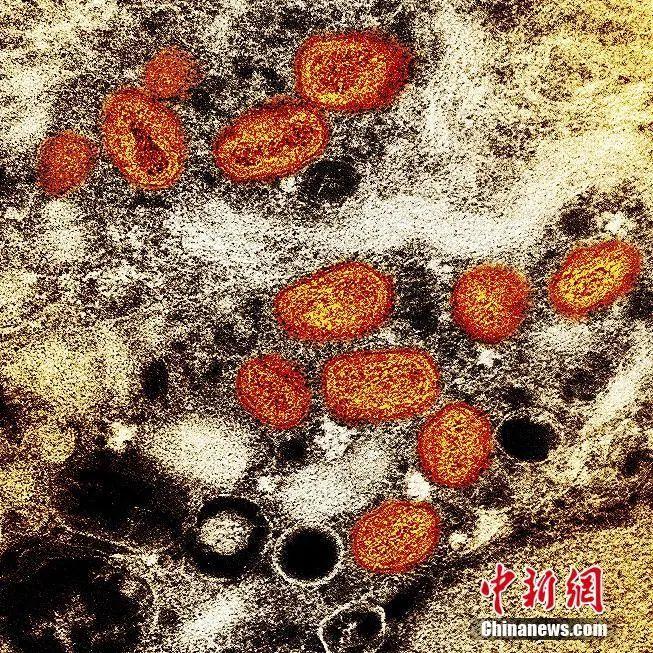 资料图:当地时间2022年7月26日,美国马里兰州,在实验室培养的感染细胞(棕色)中发现的猴痘颗粒(橙色)的彩色透射电子显微图。图片来源:视觉中国