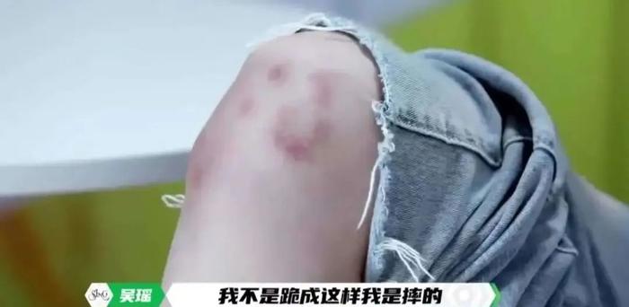 为什么女生的膝盖上经常有淤青？原因不是你们想的那样！