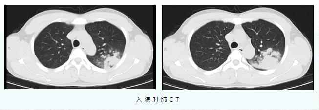 一家3口全部感染！有人肺部出现大片炎症……提醒！