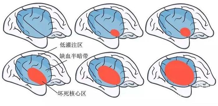 养生堂 | 播出《养生堂——世界卒中日特别节目：脑梗不能错过的24小时》