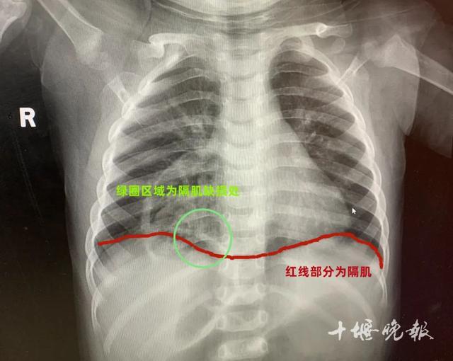 1岁幼儿大肠钻进胸腔，一查竟是这里破了洞！医生提醒