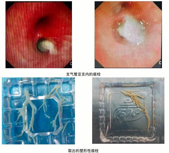 得了支原体肺炎，“洗肺”真的安全可靠吗？