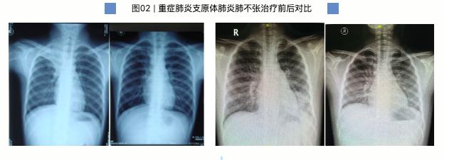 得了支原体肺炎，“洗肺”真的安全可靠吗？