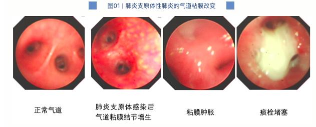 得了支原体肺炎，“洗肺”真的安全可靠吗？