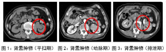 健康中国看山西：朔州市大医院泌尿外科成功开展腹腔镜一体位肾输尿管全长切除术+膀胱袖状切除术