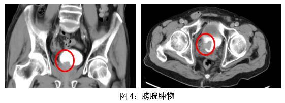 健康中国看山西：朔州市大医院泌尿外科成功开展腹腔镜一体位肾输尿管全长切除术+膀胱袖状切除术