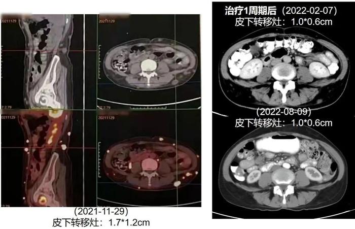 BRAF突变晚期黑色素瘤合并全身多处转移怎么办？一线双靶治疗PFS达1年