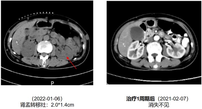 BRAF突变晚期黑色素瘤合并全身多处转移怎么办？一线双靶治疗PFS达1年