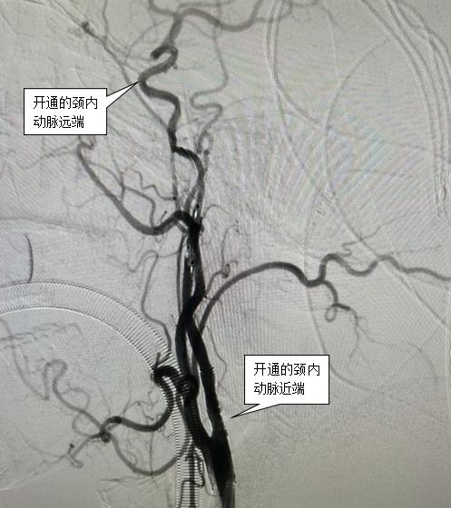 健康中国看山西：临汾市人民医院神经外科成功开展慢性颈内动脉闭塞开通术