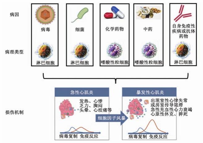 新指南出炉！中国成人暴发性心肌炎的诊疗，一文速览