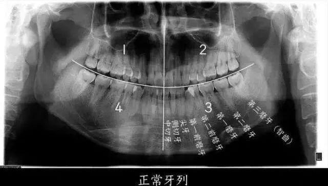 小伙拔智齿后晕倒，开颅手术14天后去世！很多人怕了：还能拔吗？