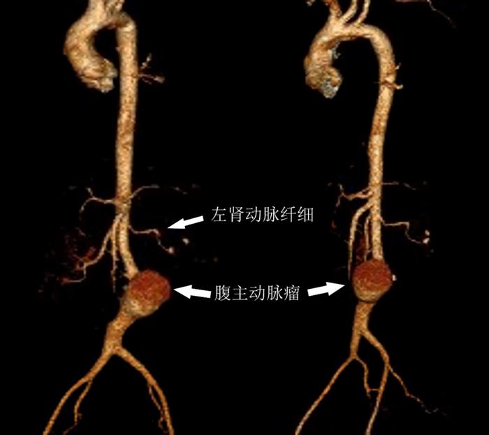 罕见！4岁女童腹痛竟是凶险腹主动脉瘤