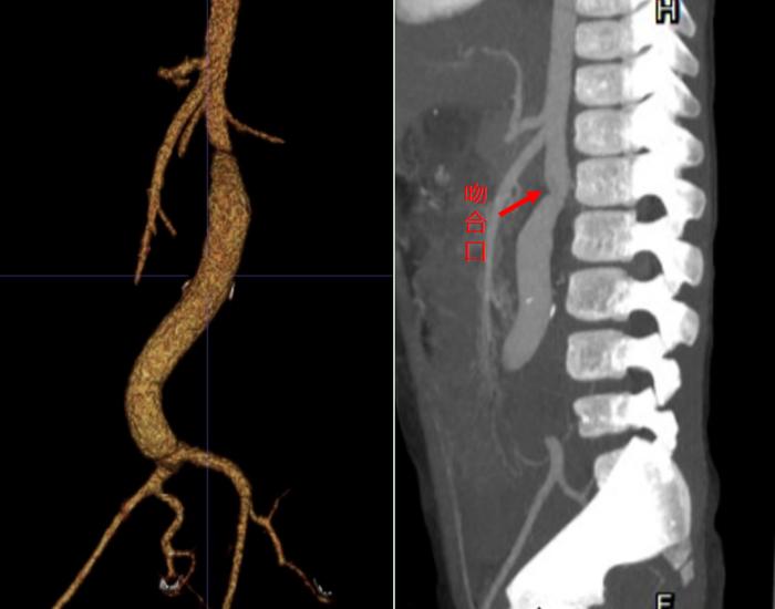 罕见！4岁女童腹痛竟是凶险腹主动脉瘤