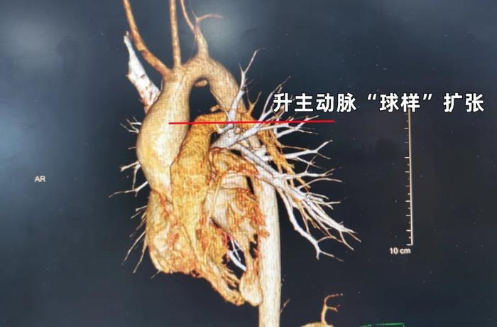 13岁男孩“心门”堵塞，一年晕厥4次，医生迎战高难度手术