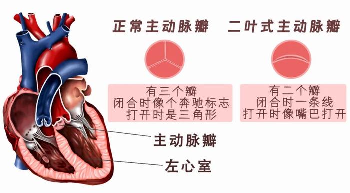 13岁男孩“心门”堵塞，一年晕厥4次，医生迎战高难度手术