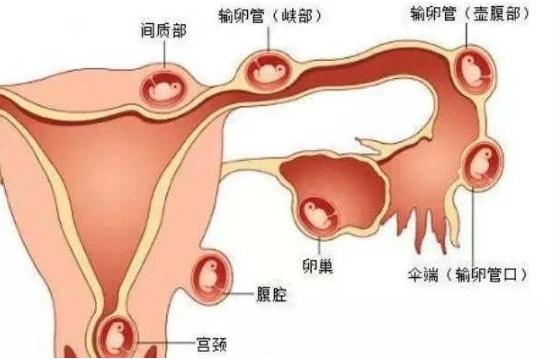 汤医科普 | 宫外孕有哪些症状