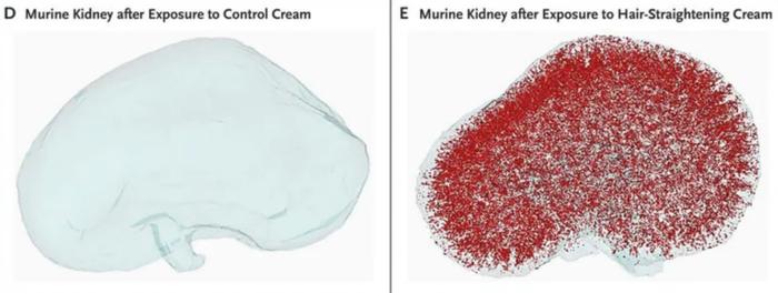 两年3次急性肾损伤，竟是用了这类直发膏