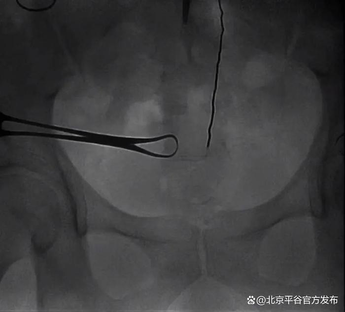 技术“上新”！北京友谊医院平谷医院首例DSA引导下套管穿刺腹膜透析置管术成功实施