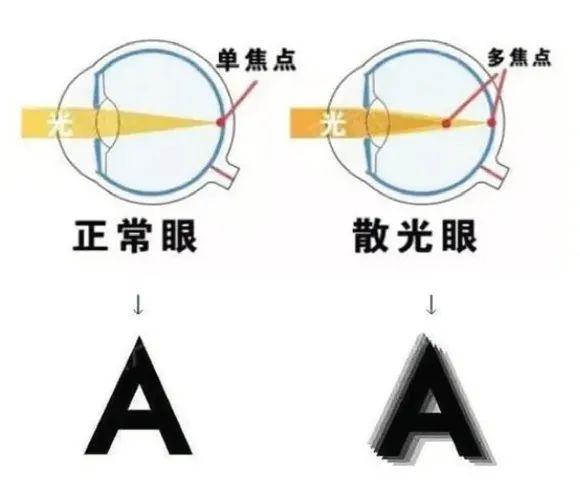 散光的是什么镜,散光是什么原因造成的