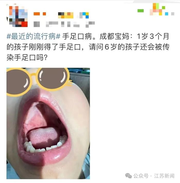 5岁以下儿童易发！这种病已进入高发期！严重可致命！