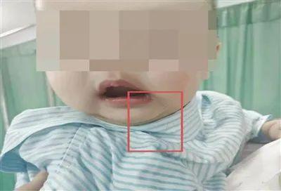 海南一7月龄宝宝吃了根头发，结果要全麻做手术……医生：实在罕见！