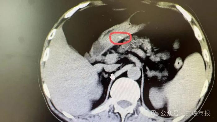 宜昌男子被紧急送医，体内竟取出5cm异物