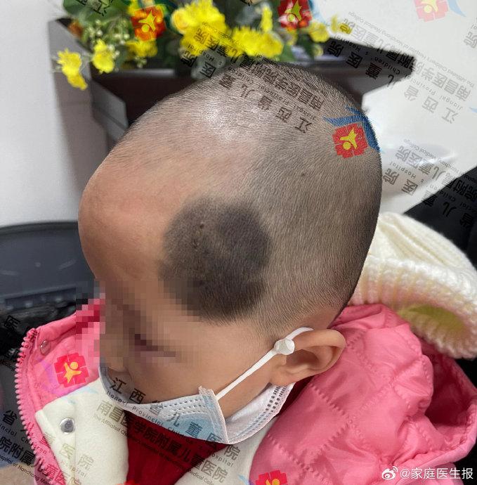 江西2岁女童头部先天性黑素细胞痣，江西省儿童医院整形美容科为其“斩草除根”