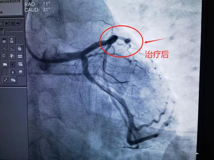 “痛得喘不过气”！两个小伙紧急抢救！越来越多年轻人中招……