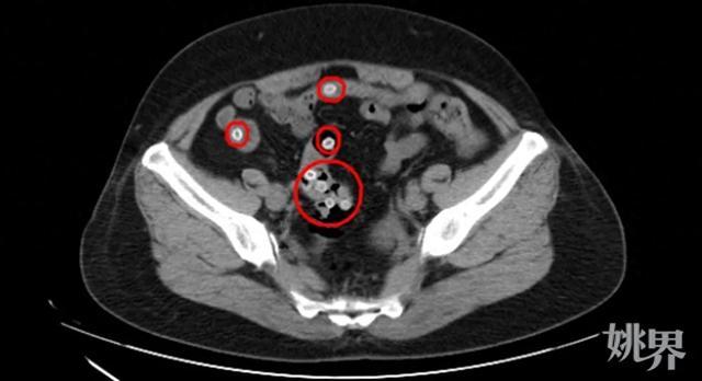 女子肠道里密密麻麻全是……痛不欲生！医生：不能这么吃啊！