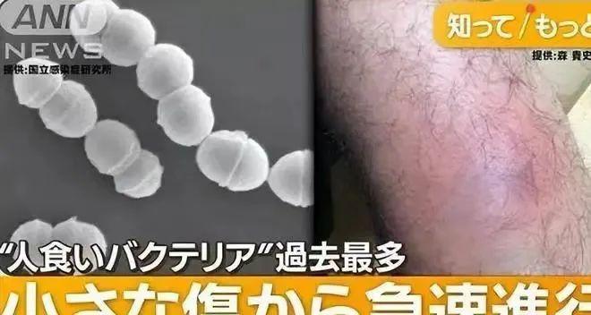 “食人菌”疯传日本 图源:日媒