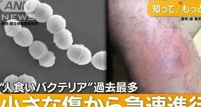 日本感染超千例！致死率达30%，“食人菌”到底是什么？