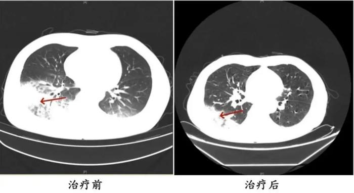 接连有人确诊，严重者可致死！传染源可能是它，最近几乎家家都在用……