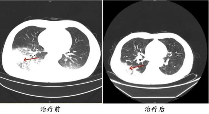 接连2人确诊，其中一人重症！感染源可能是它，最近很多人在用……