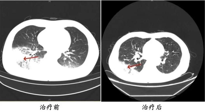 发热+咳嗽！接连有人确诊，还有人重症！赶紧检查你家空调