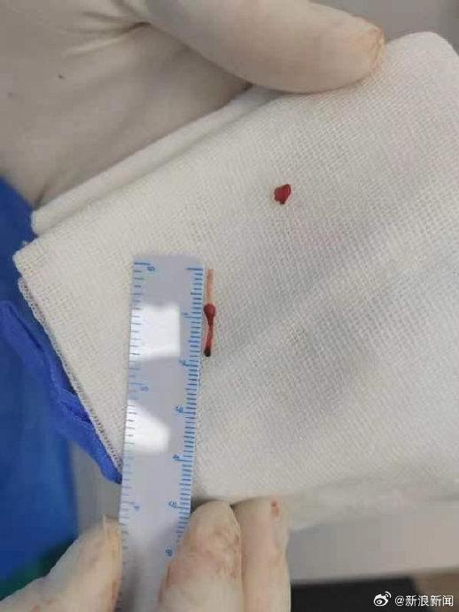 留置针头导管：婴儿血管漂浮5年 病院 微风 北京市 第3张
