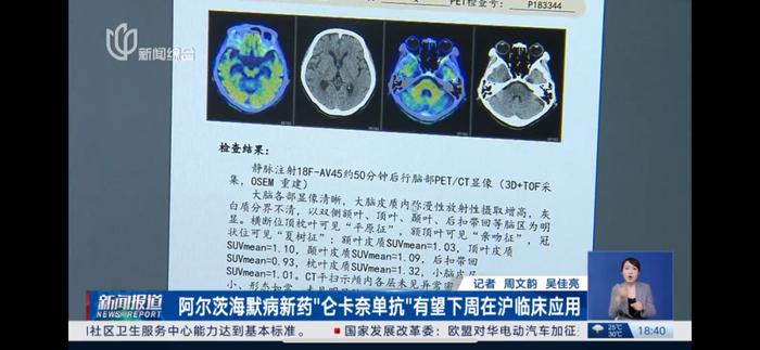 阿尔茨海默病重磅新药下周在上海投入临床，费用已公开