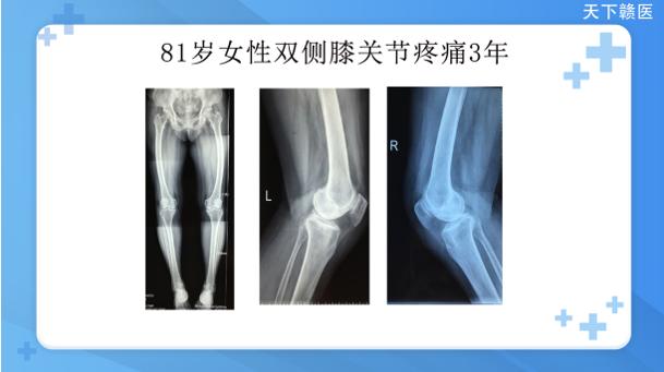 心生自卑、疼痛不已！性格开朗的她3年不愿出门……