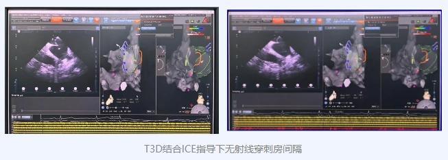 哈尔滨医科大学附属第四医院心内科乐成开展Marshall静脉+射频消融治疗顽固性房颤（内科好的医院）哈尔滨医科大学第四附属医院神经内科，