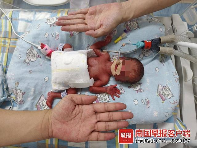 7公斤啦！出生仅900克的“巴掌宝宝”被救治后健康出院