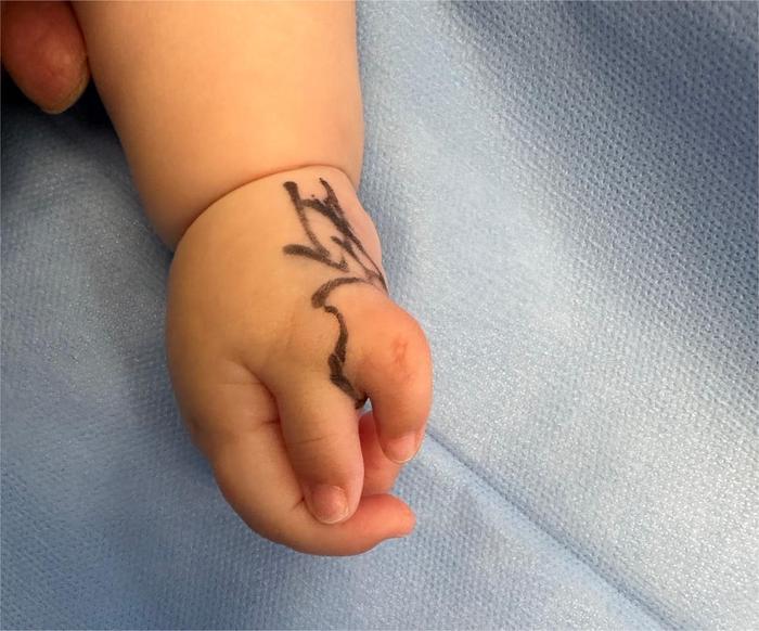 五月龄男婴右手多一个拇指犹如“蟹钳”，上海医生手术修复