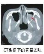 “我鼻子发霉了！”杭州女子确诊，长出和乒乓球一样大……当季高发，很多人以为是感冒